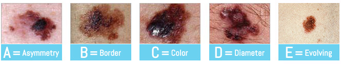 The abcde signs of melanoma