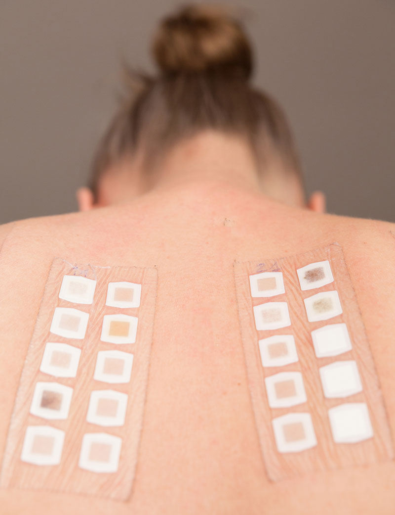 Patch testing for skin allergies