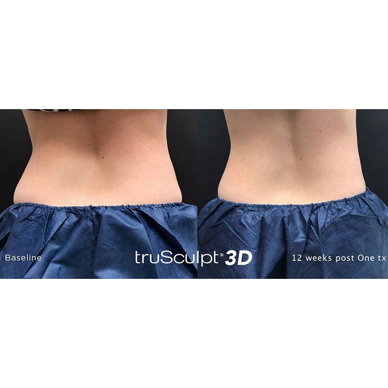 truSculpt 3D Before and After Photo Columbia Skin Clinic