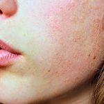 Young woman with rosacea