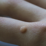 person's hand with a wart - how to get rid of warts