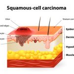 Squamous Cell Carcinoma: What You Should Know
