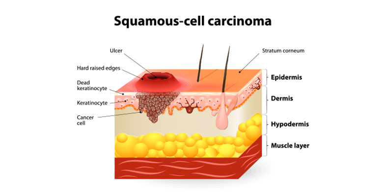 Squamous Cell Carcinoma Columbia Skin Clinic