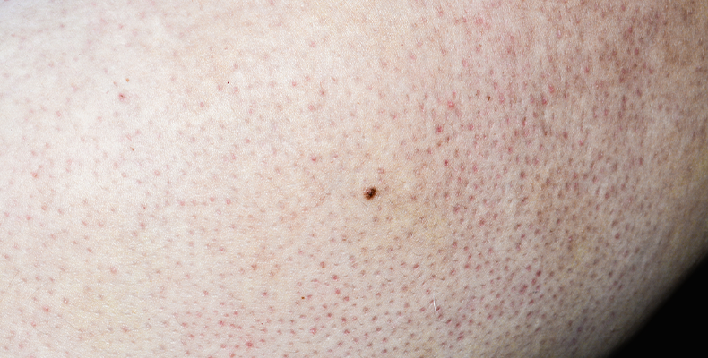 Chicken Skin On Arms