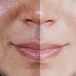 The Truth about Hyperpigmentation