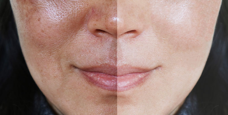 The Truth About Hyperpigmentation - Columbia Skin Clinic
