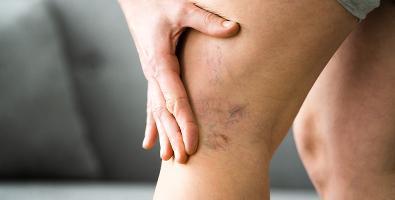 How to Treat Leg Veins  Center for Surgical Dermatology