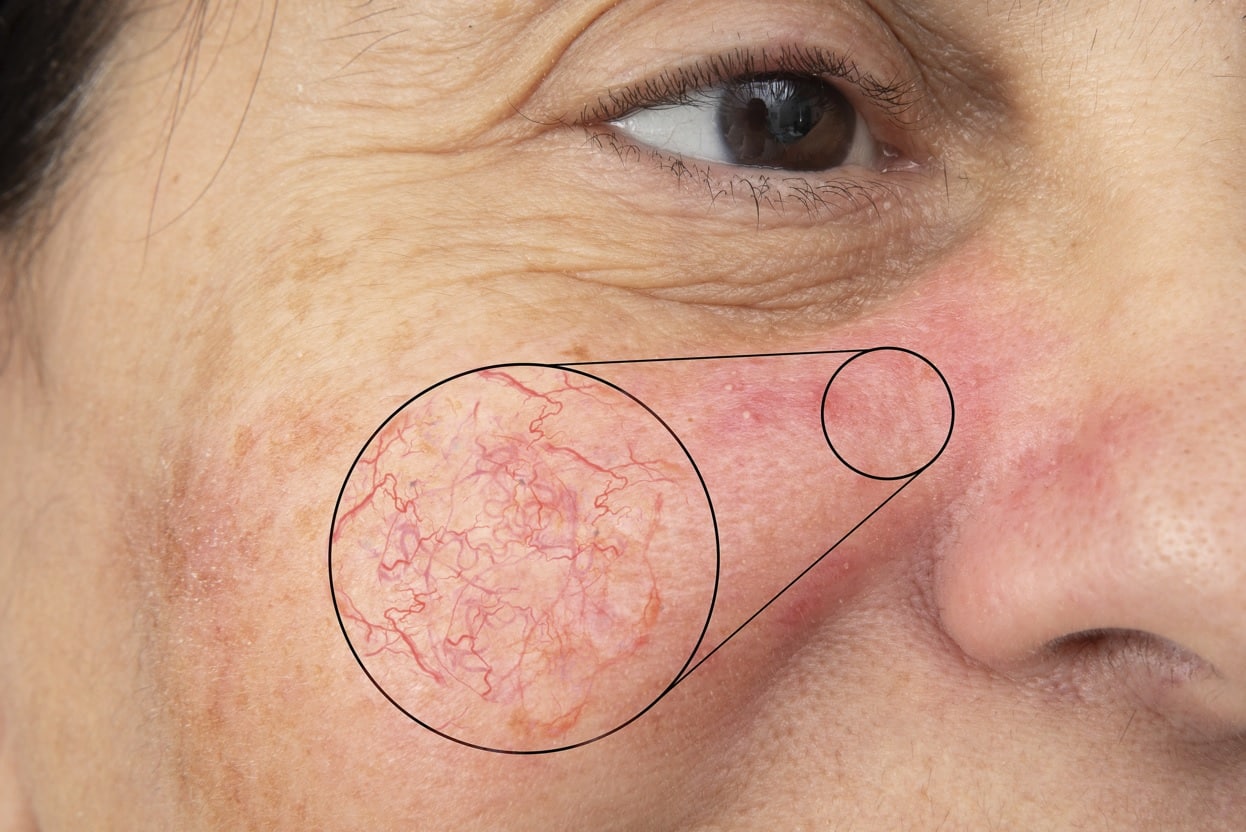 Broken Capillaries – Cause and Treatment