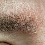 close-up of a person's eyebrow with seborrheic dermatitis skin condition