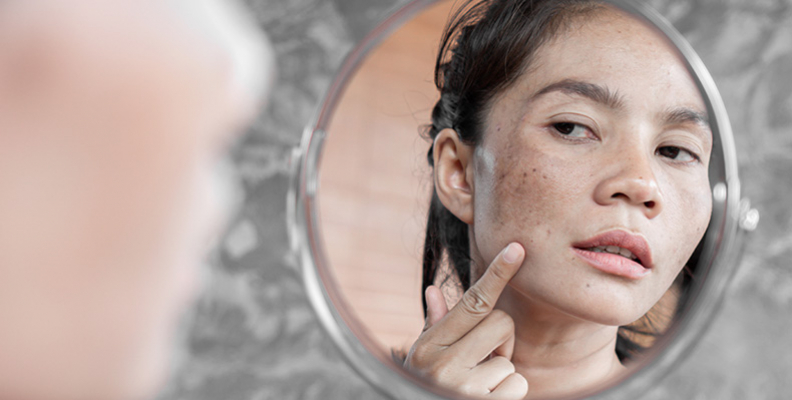 Hyperpigmentation Vs Melasma Understanding The Difference hyperpigmentation vs melasma