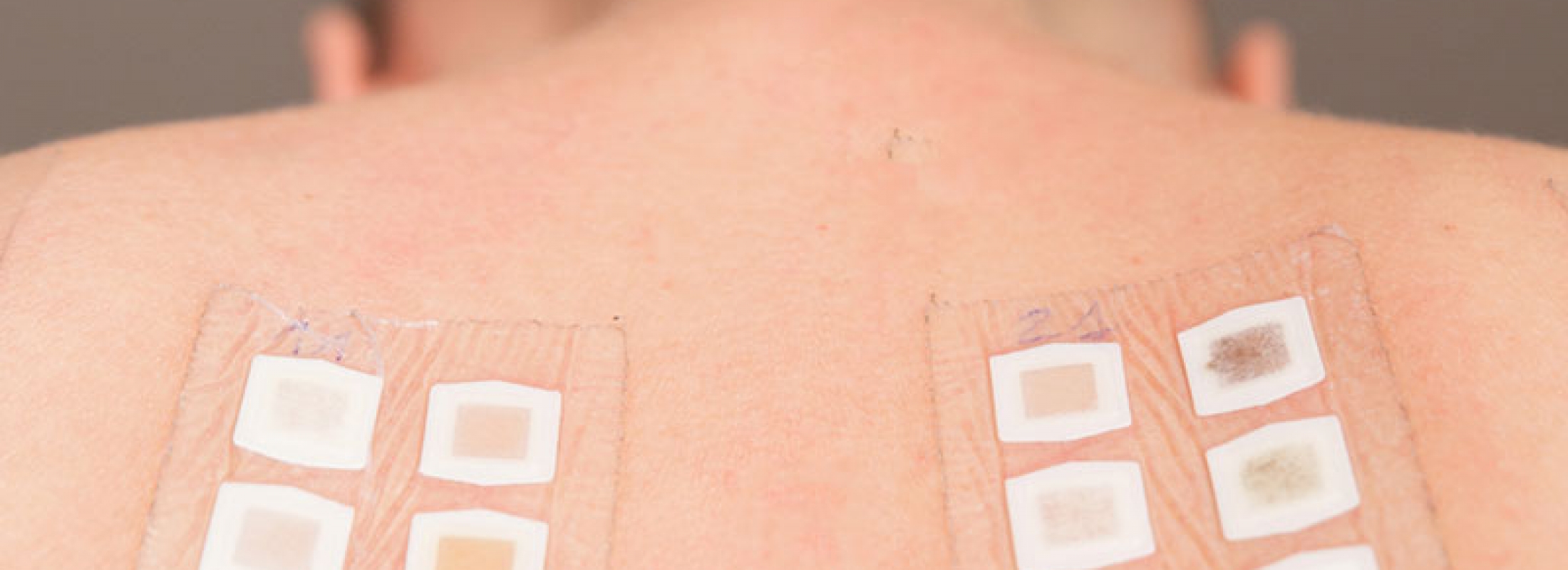 Patch testing for skin allergies - Columbia Skin Clinic