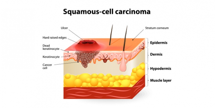 Skin Cancer Archives | Columbia Skin Clinic