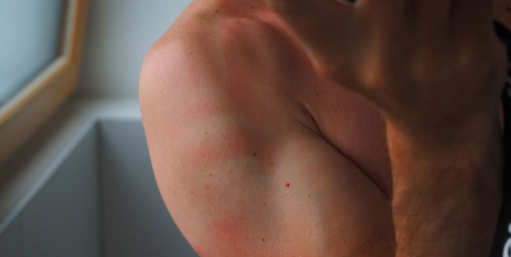 The Best Sunburn Treatments - Columbia Skin Clinic