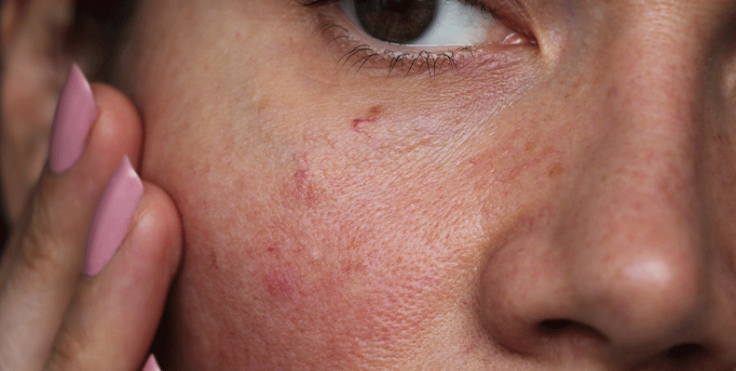 Why is My Skin so Sensitive? | Columbia Skin Clinic